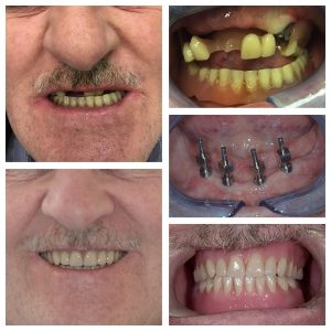 Dental Implants Case